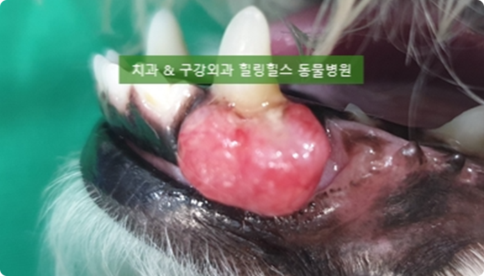치은종<br> (극세포형 법랑 모세포종)<br> 치료전
