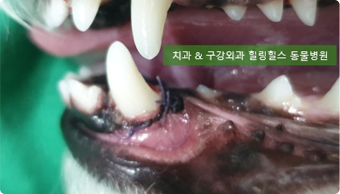 치은종<br> (극세포형 법랑 모세포종)<br> 치료후